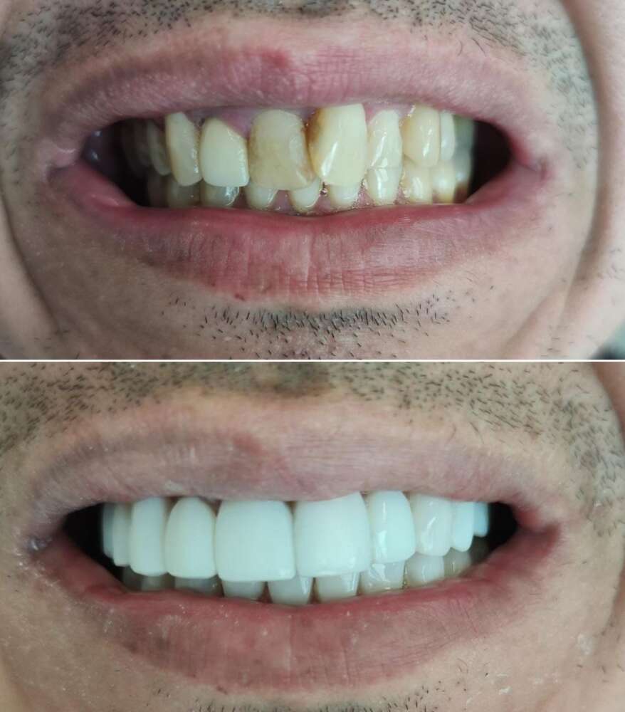 Sorriso antes e depois das facetas em resina - Foto: Divulgação